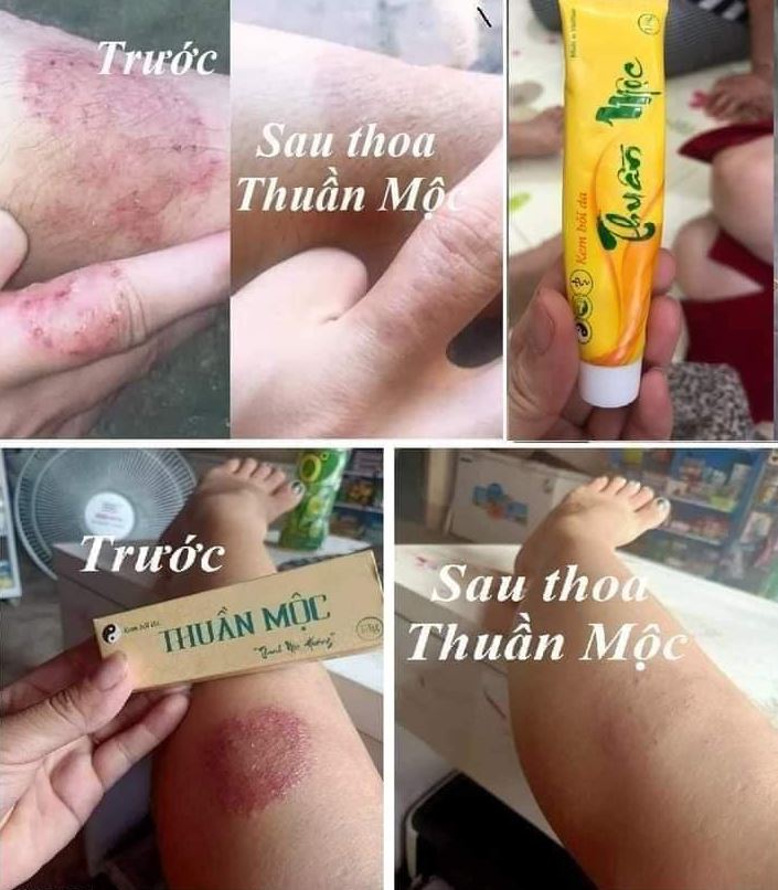 Sản phẩm hỗ trợ điều trị nhiều tình trạng da khác nhau