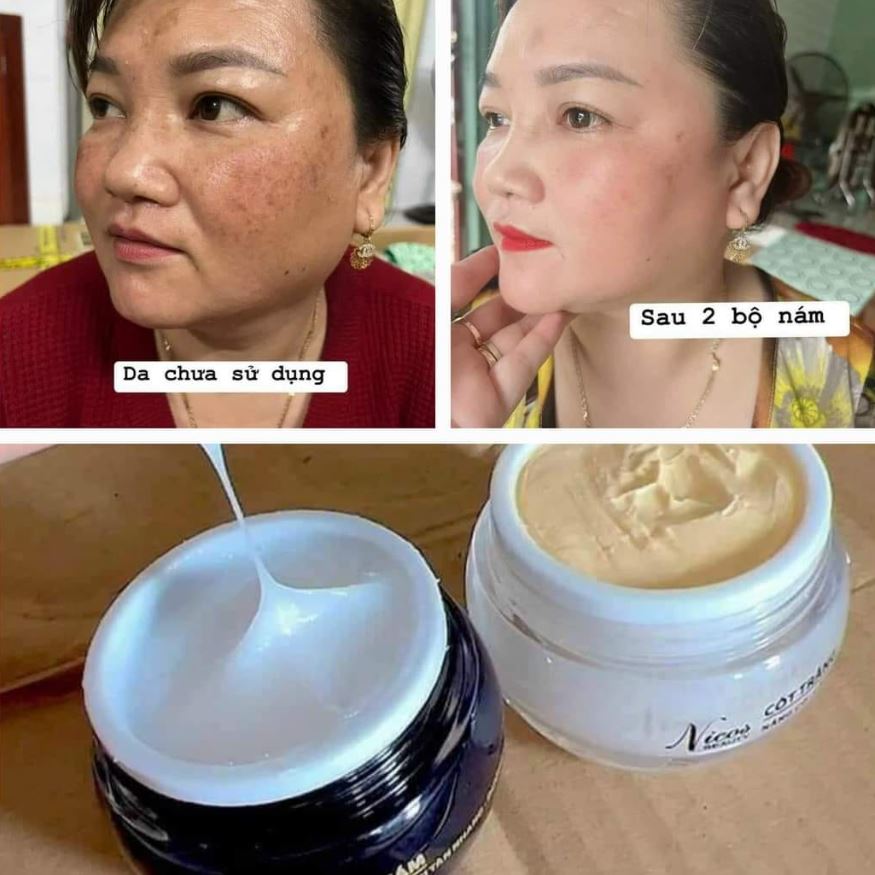 Review Combo Cốt Nám Đông Y Nikos từ khách hàng