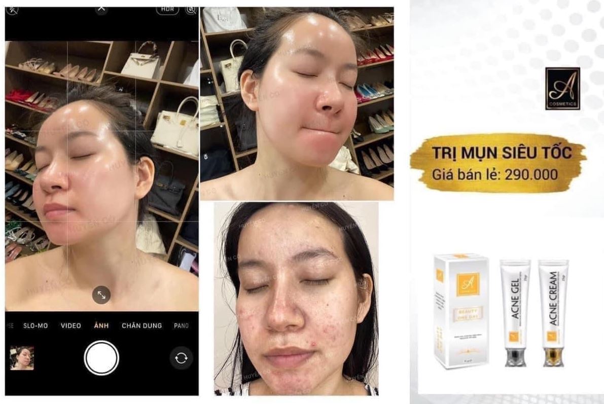 Đánh giá từ người dùng về Combo Mụn Acne Cream & Acne Gel