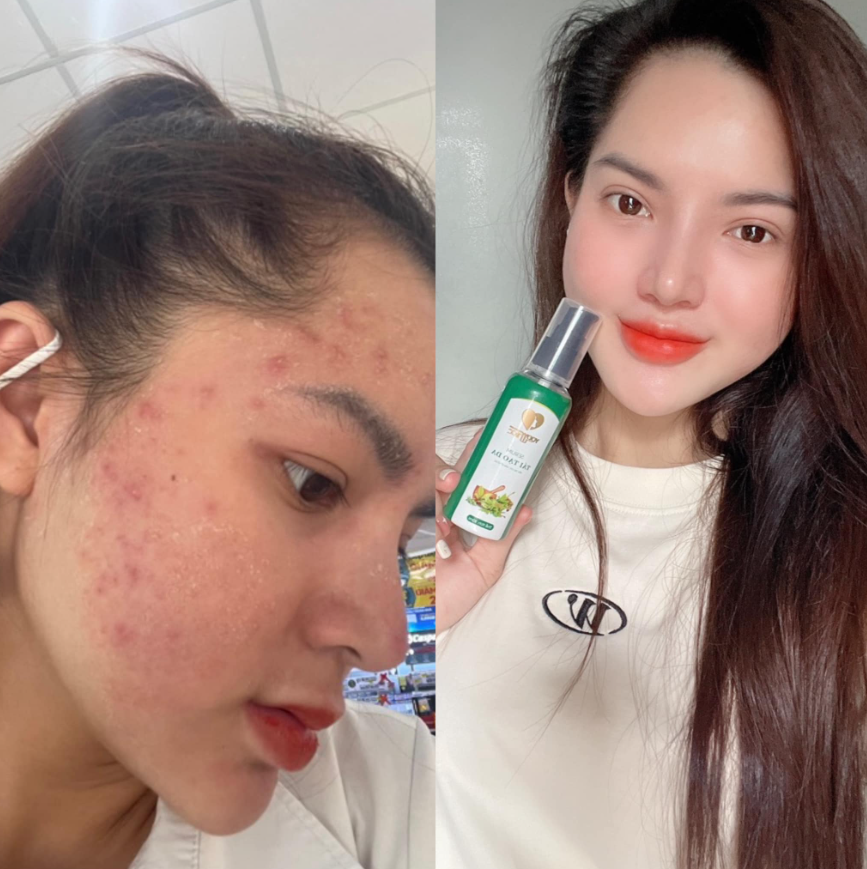 Serum Tái Tạo Da Phương Anh Yody White- Sali Beauty