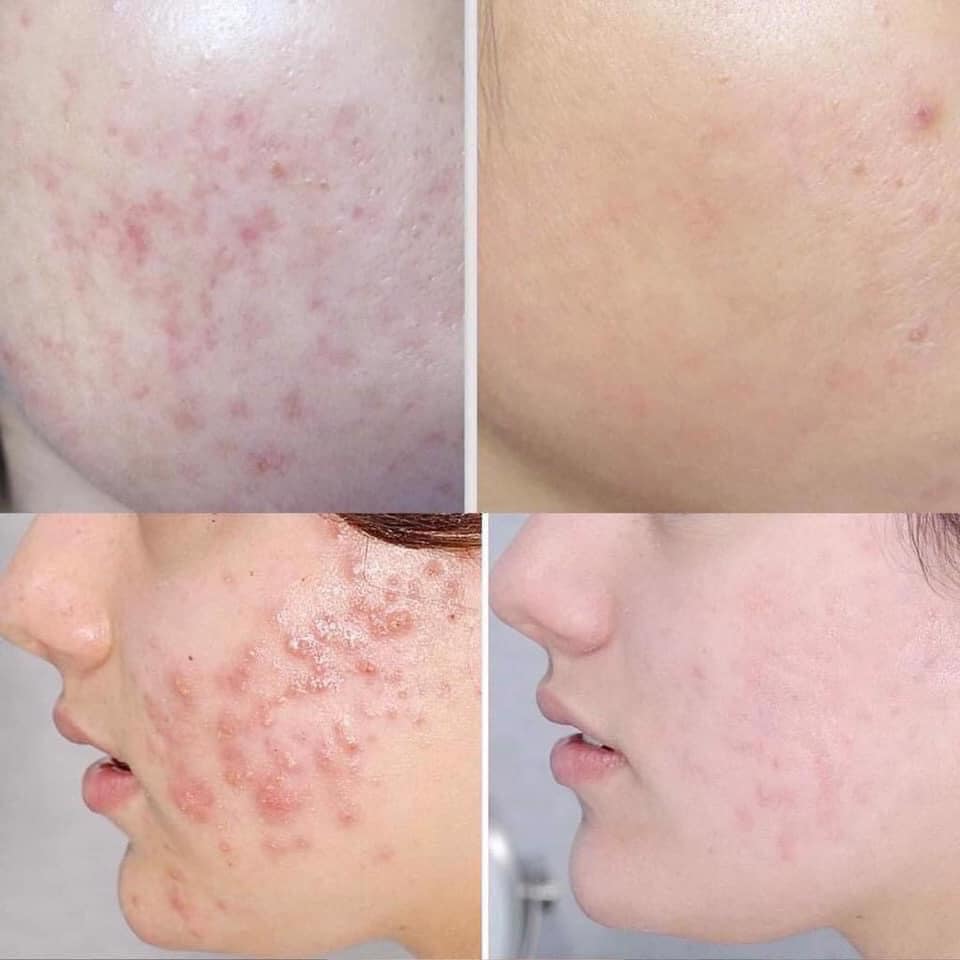 Phù hợp với mọi làn da, đặc biệt là làn da bị tổn thương