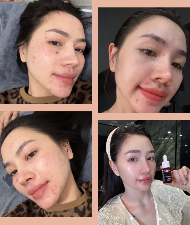 Người có làn da bị mụn