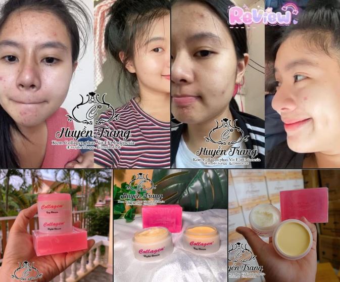 Người bị nám, tàn nhang, sạm da lâu năm.