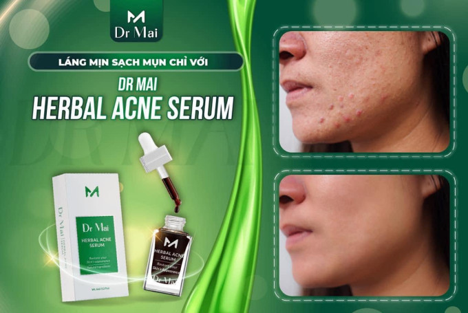 Dr Mai nguyên chất – Dr Mai Herbal Acne hỗ trợ chăm sóc da mụn